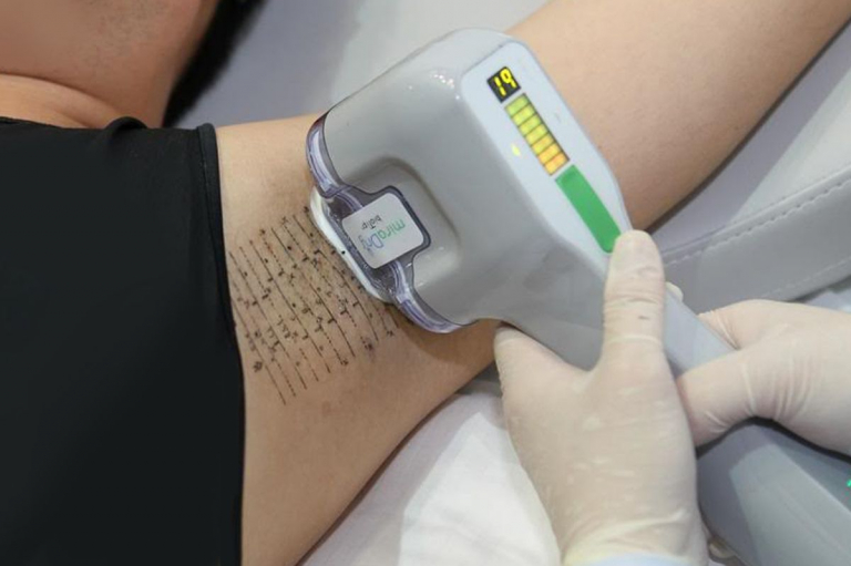 A person getting laser hair removalAI-generated content may be incorrect.